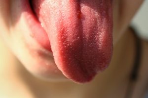 síndrome de la boca ardiente