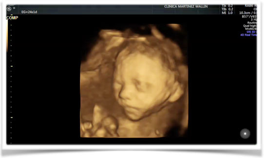 ecografía durante el embarazo eco 3D Clínica Martinez Wallin